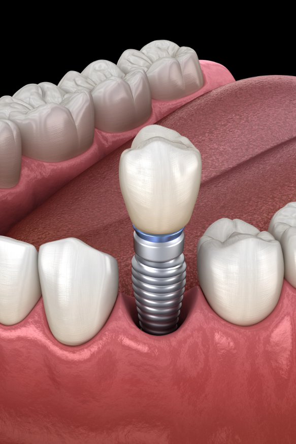 Implantat